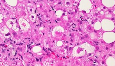 Doctors, liver specialist team up to better fight hepatitis in Alberta