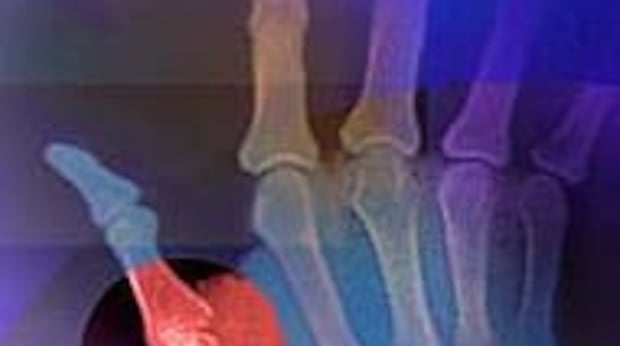 Arthritis crisis: Research shows the individual and societal costs of the disease in N.L. are staggering