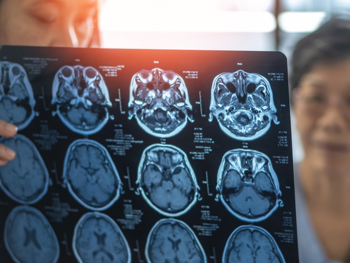 Older Americans have dementia without knowing—experts reveal signs to watch