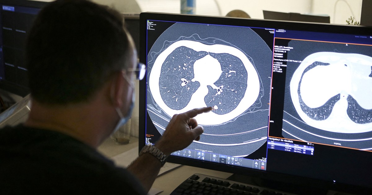 Newly approved pancreatic cancer drug shows promise in lung cancer - NBC News