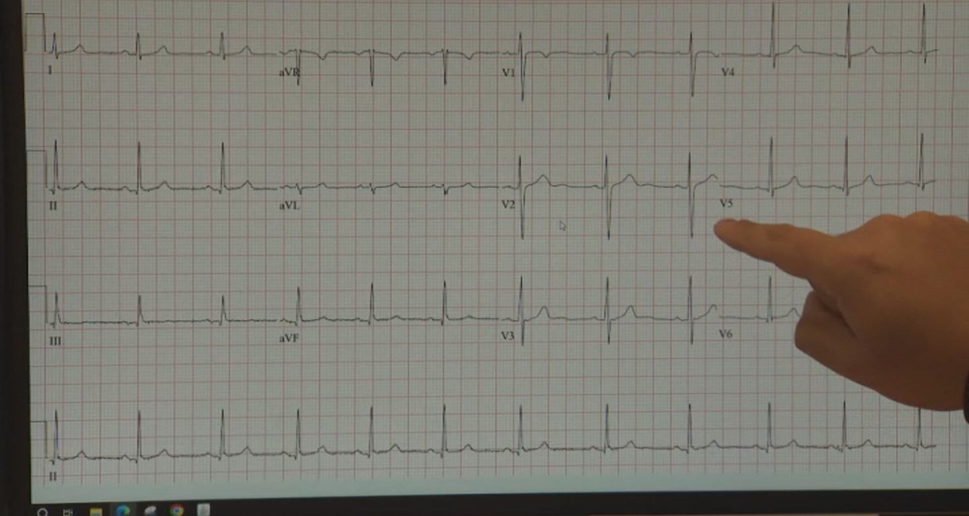 Montreal cardiologists perform Canada's first-of-kind procedure to treat blood clots and arrhythmia at once