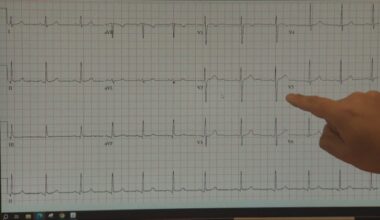Montreal cardiologists perform Canada's first-of-kind procedure to treat blood clots and arrhythmia at once