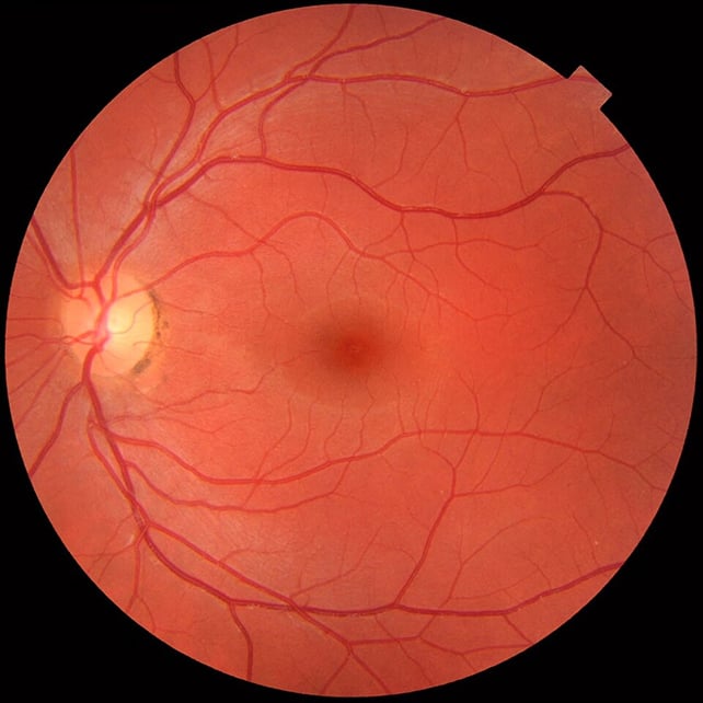 Retina scan