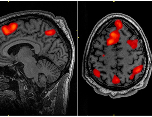 Bulimia nervosa linked to structural differences in brain regions