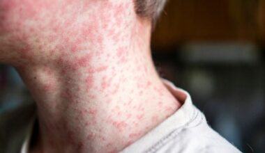 Halton Region Public Health confirms second case of measles