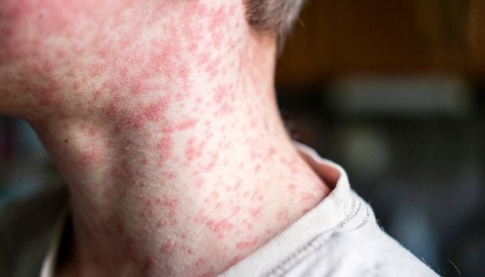 Halton Region Public Health confirms second case of measles