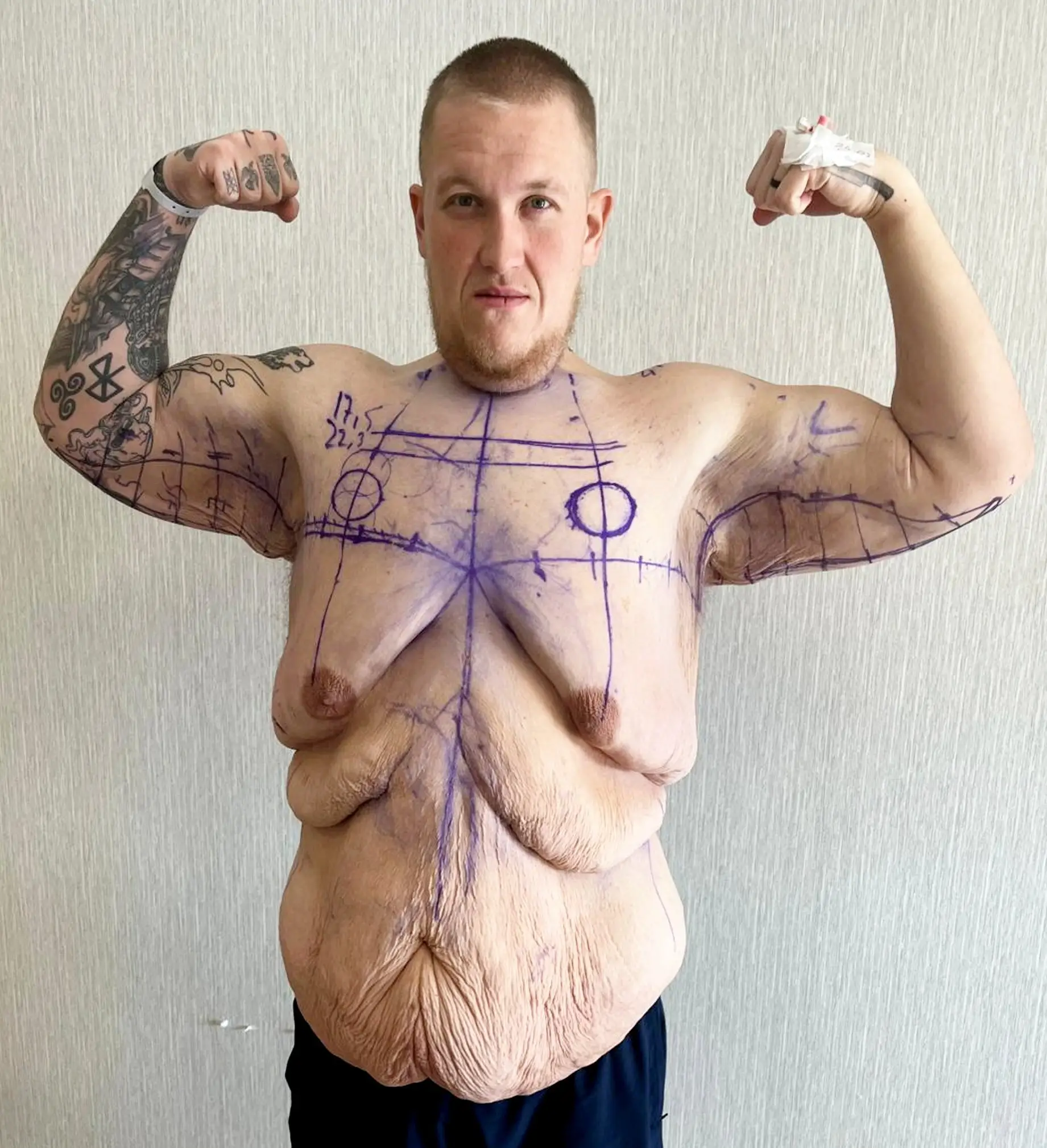 The dad also had excess skin removed (SWNS)