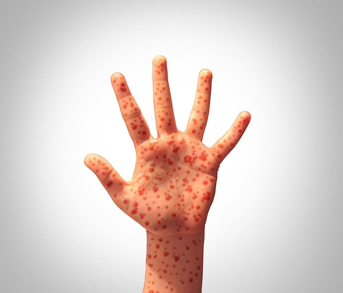Fourth measles-associated death reported in Pennsylvania outbreak