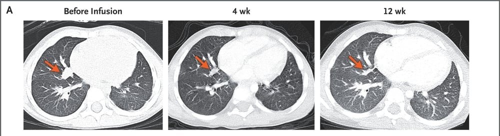 Collage of three CT scans showing a hepatoblastoma tumor shrinking after CAR T cell treatment.