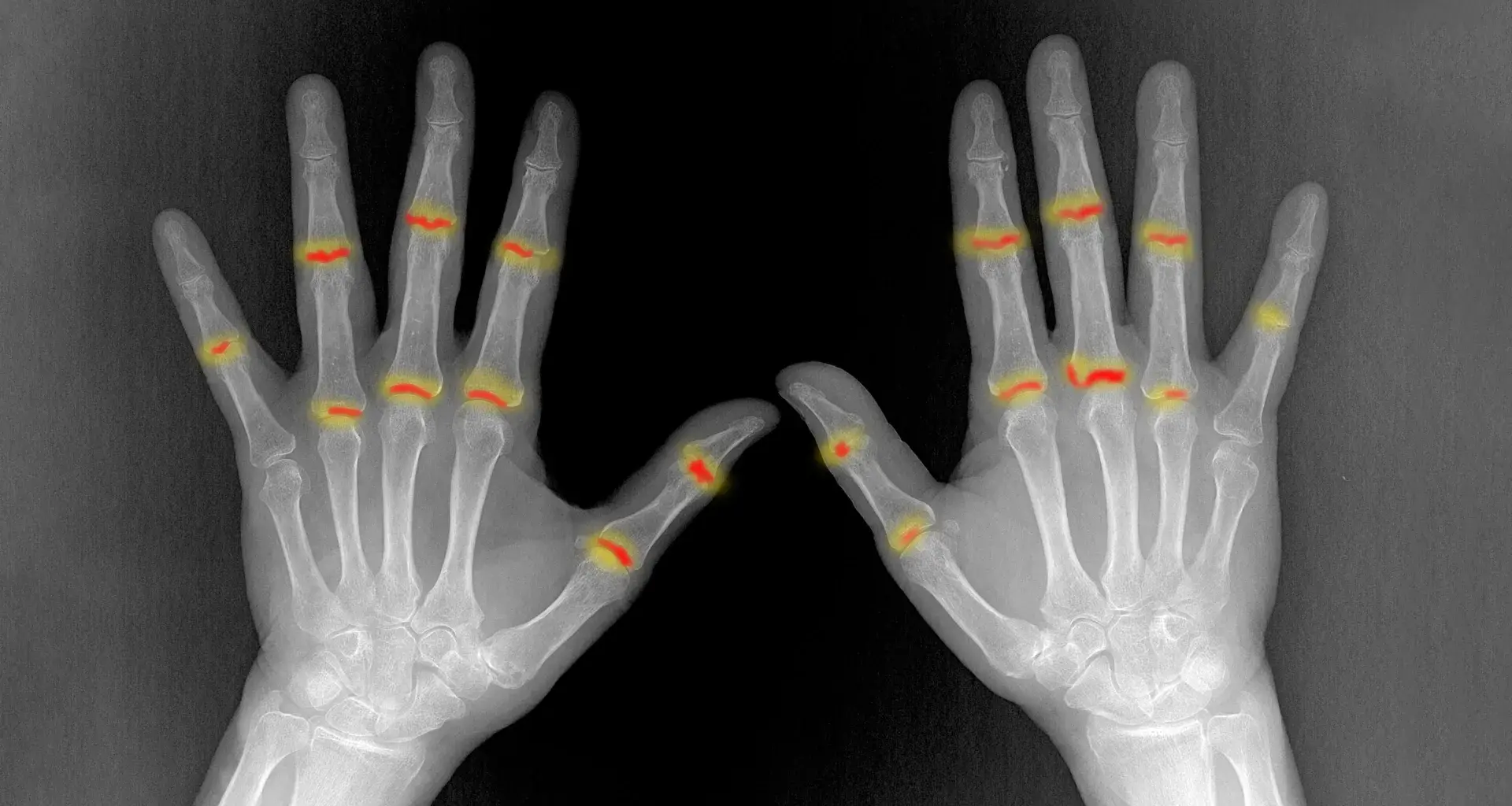 Some joints may be primed for rheumatoid arthritis before birth