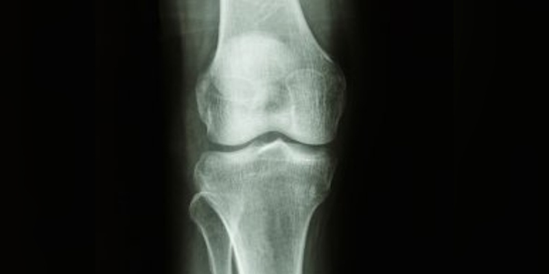With Current Wait Times Around Four Years, Chief of Orthopaedics Wants Dedicated Centre for Hip and Knee Replacements
