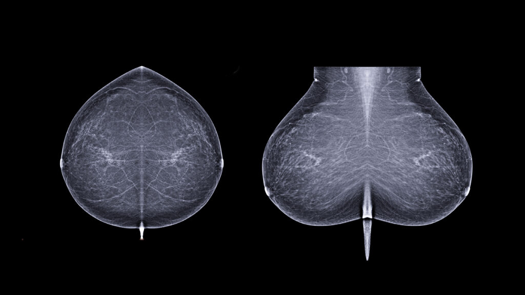 Why this startup is taking its AI to predict breast-cancer risk directly to patients