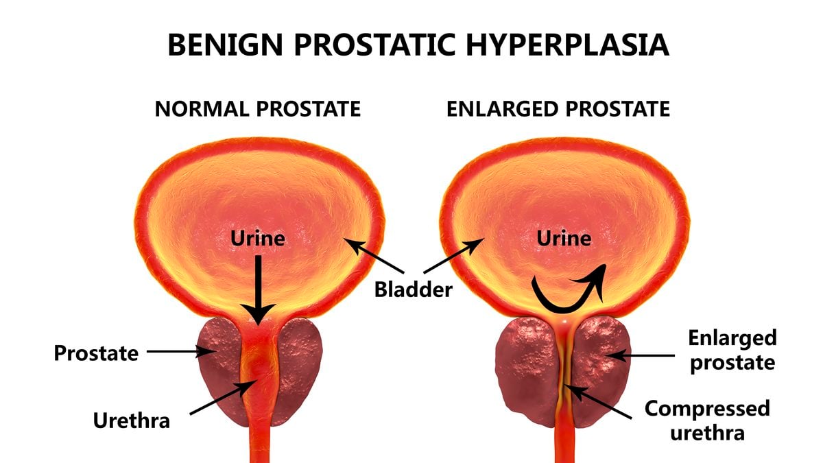 Scientists May Have Discovered Why Men's Prostates Enlarge With Age