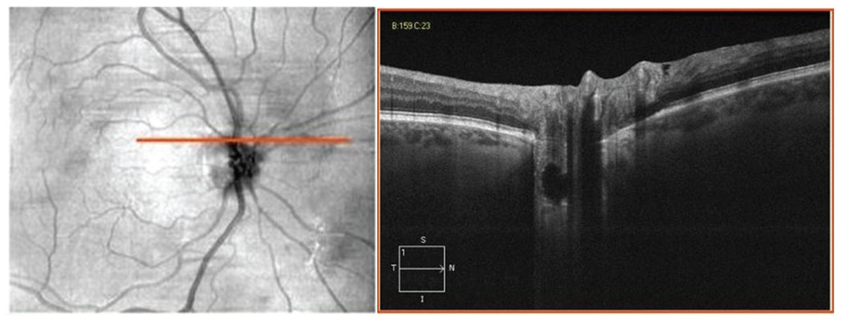 Optic disc drusen imaged with EDI-OCT.