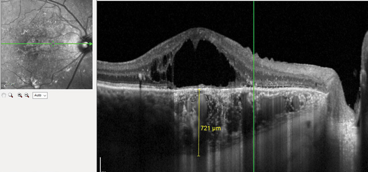 Chronic central serous chorioretinopathy with pachychoroid imaged with EDI-OCT.