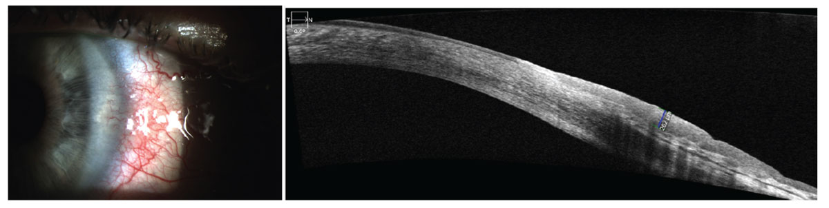 Ocular surface squamous cell neoplasia imaged with AS-OCT. There is a thickened and hyperreflective epithelial layer with an abrupt transition from normal to abnormal epithelium.