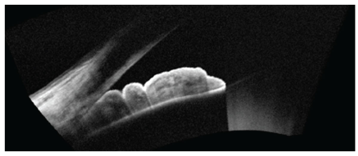 Iridocorneal contact imaged with AS-OCT.