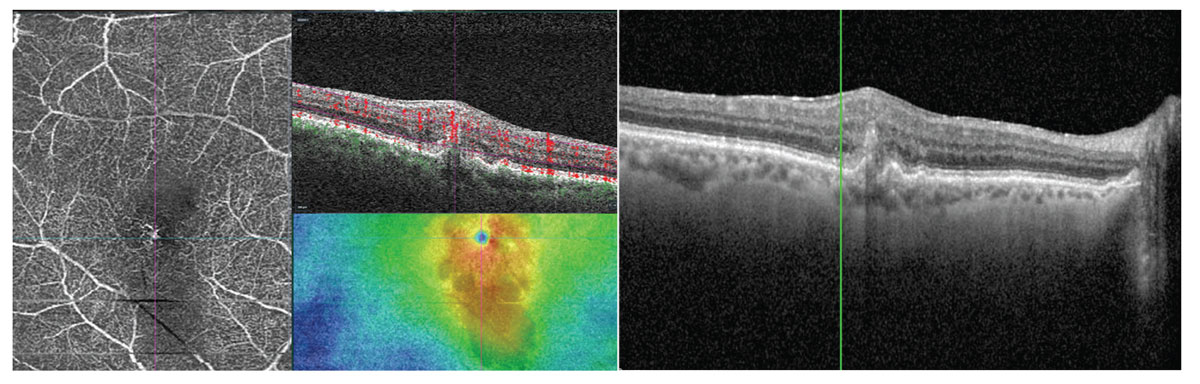 Type 3 MNV imaged with OCT-A with intraretinal neovascularization.
