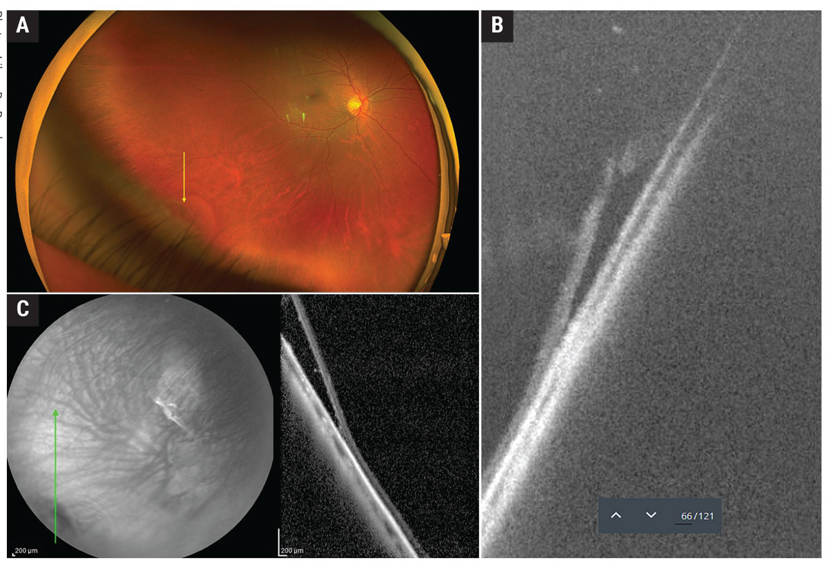 Shallow retinal detachment associated with retinal break imaged with UWF OCT (A and B)and WF OCT (C). 
