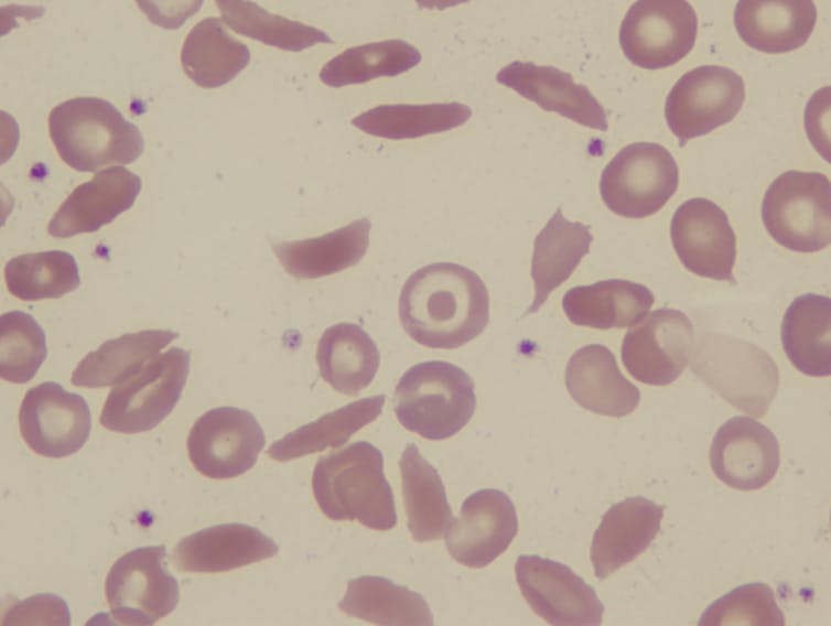microscopic photograph of round and sickle-shaped red blood cells