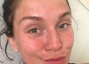 Vicky Pattison's main concern was rosacea, says Dr Bal