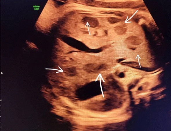 Case report: fetal hemangioendothelioma in a pregnant patient with gestational diabetes mellitus | Egyptian Journal of Radiology and Nuclear Medicine