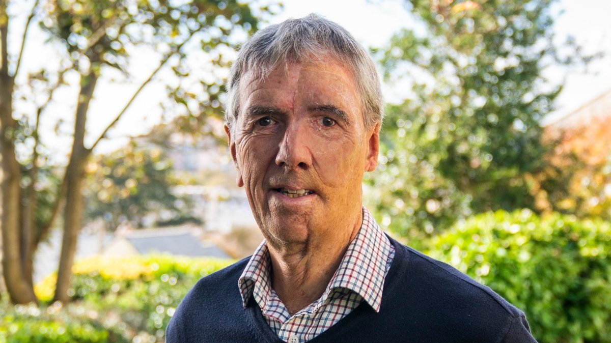 Cycling crash victim receives new face with help of 3D printing