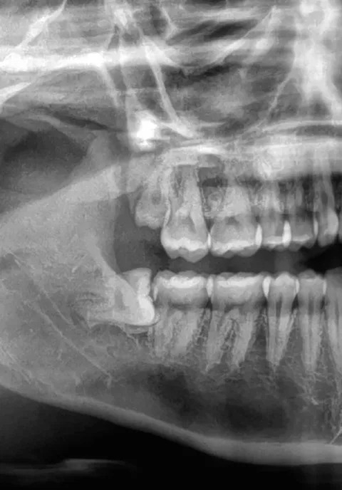 Dental X-ray showing teeth and jaw alignment, highlighting a wisdom tooth impacted horizontally behind molars