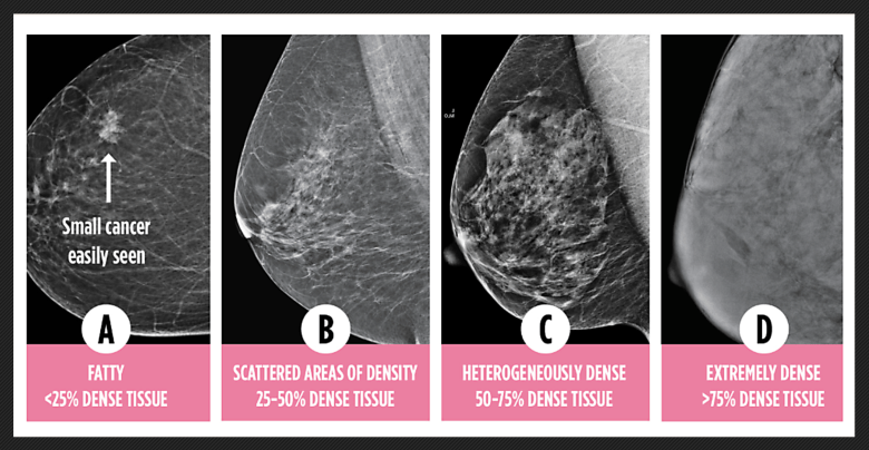 A graphic showing mammograms of four breasts indicating levels of density for each, from letter A to letter D.