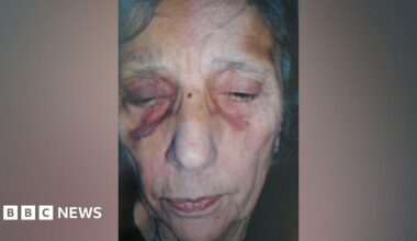 A close up of Iris Scott's face which has visible purple and yellow bruising on her temples and around her eye sockets.