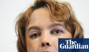 Face transplants promised hope. Patients were put through the unthinkable | Science