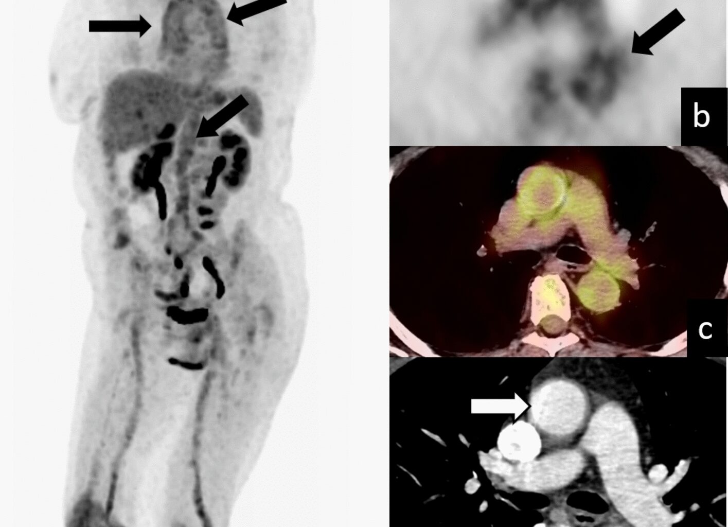Hybrid imaging of aortitis through 18F-FDG PET/CT and computed tomography angiography: a pictorial review | Egyptian Journal of Radiology and Nuclear Medicine
