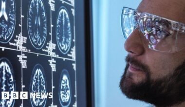 Obesity drug semaglutide fails to slow Alzheimer's