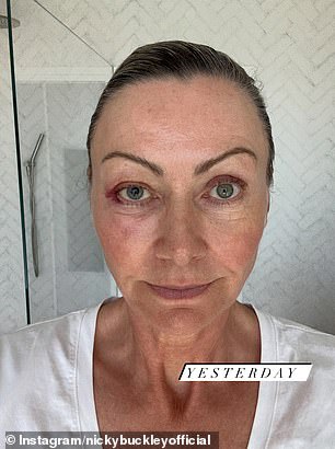 She shared raw before-and-after photos that show significant bruising and swelling around one eye
