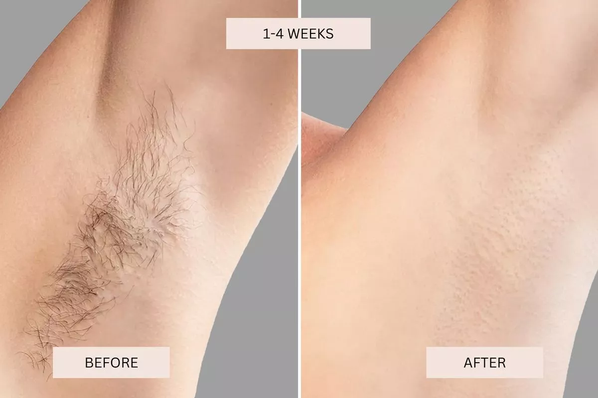 Keskine IPL Hair Removal Handset