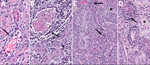 Histopathologic findings in reproductive tissues from strain 13/N guinea pigs serially euthanized 4–16 days postinfection (dpi) after Lassa virus strain Josiah infection in study of guinea pig model for infection of reproductive tract and considerations for sexual and vertical transmission. A) Perivascular mononuclear infiltrates (arrow) in oviduct (12 dpi). B) Perivascular (arrow) and interstitial (asterisk) lymphoplasmacytic infiltrates within the myometrium in uterus (16 dpi). C) Interstitial and perivascular lymphoplasmacytic infiltrates (arrows), with rare single cell necrosis of the tubular epithelial cells (asterisk) in epididymis (16 dpi). D) Mild perivascular and vascular inflammation (arrow) and interstitial edema (asterisk) in epididymis (16 dpi). Hemotoxylin and eosin stain. Original magnifications ×40 (panels A, B, D) ×20 (panel C).