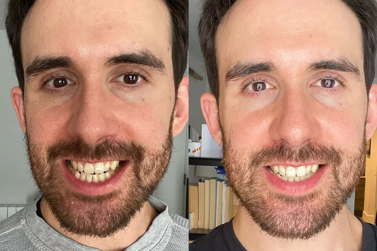 Before and after using MySweetSmile