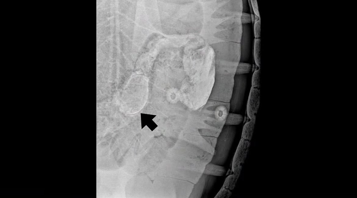 Similan sea turtle rescued after swallowing tourist's wristband