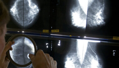 AI firms believe mammograms can spot multiple health risks