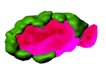 Alzheimer’s, Parkinson's, and Cancer