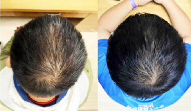 New plant-based serum shown to regrow hair in weeks