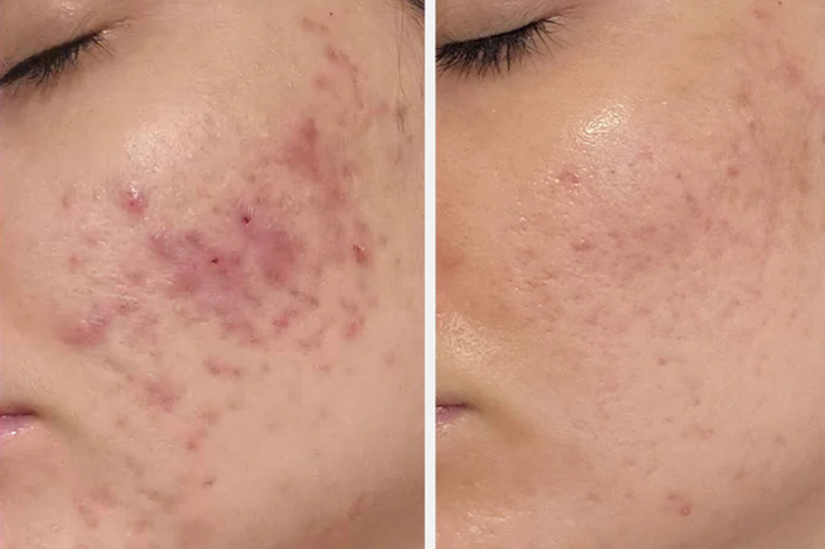 Lora before and after using Dr Sam's Flawless Neutralising Gel for 16 weeks