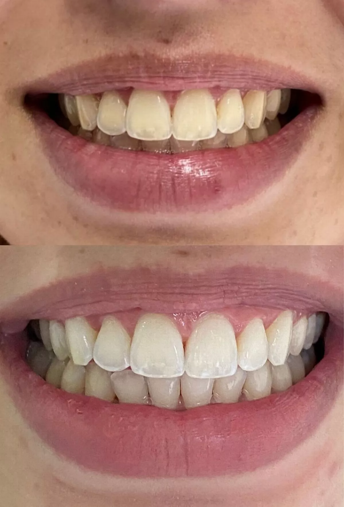 Before and after using the HeySmile Teeth Whitening Strips.