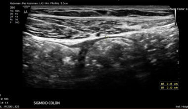 A Game Changer for IBD Care: The Advantages of Intestinal Ultrasound
