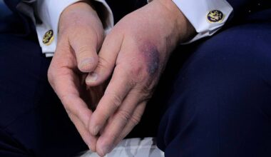 Trump says heavy bruise on hand came after he 'clipped it' on table