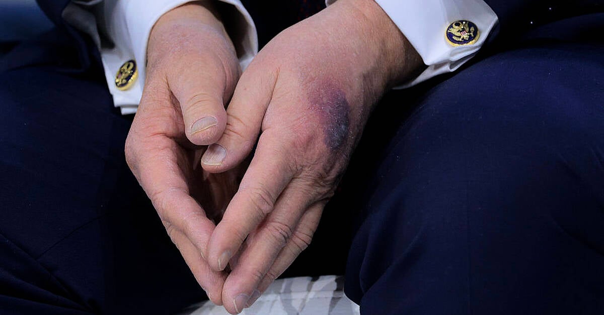 Trump says heavy bruise on hand came after he 'clipped it' on table