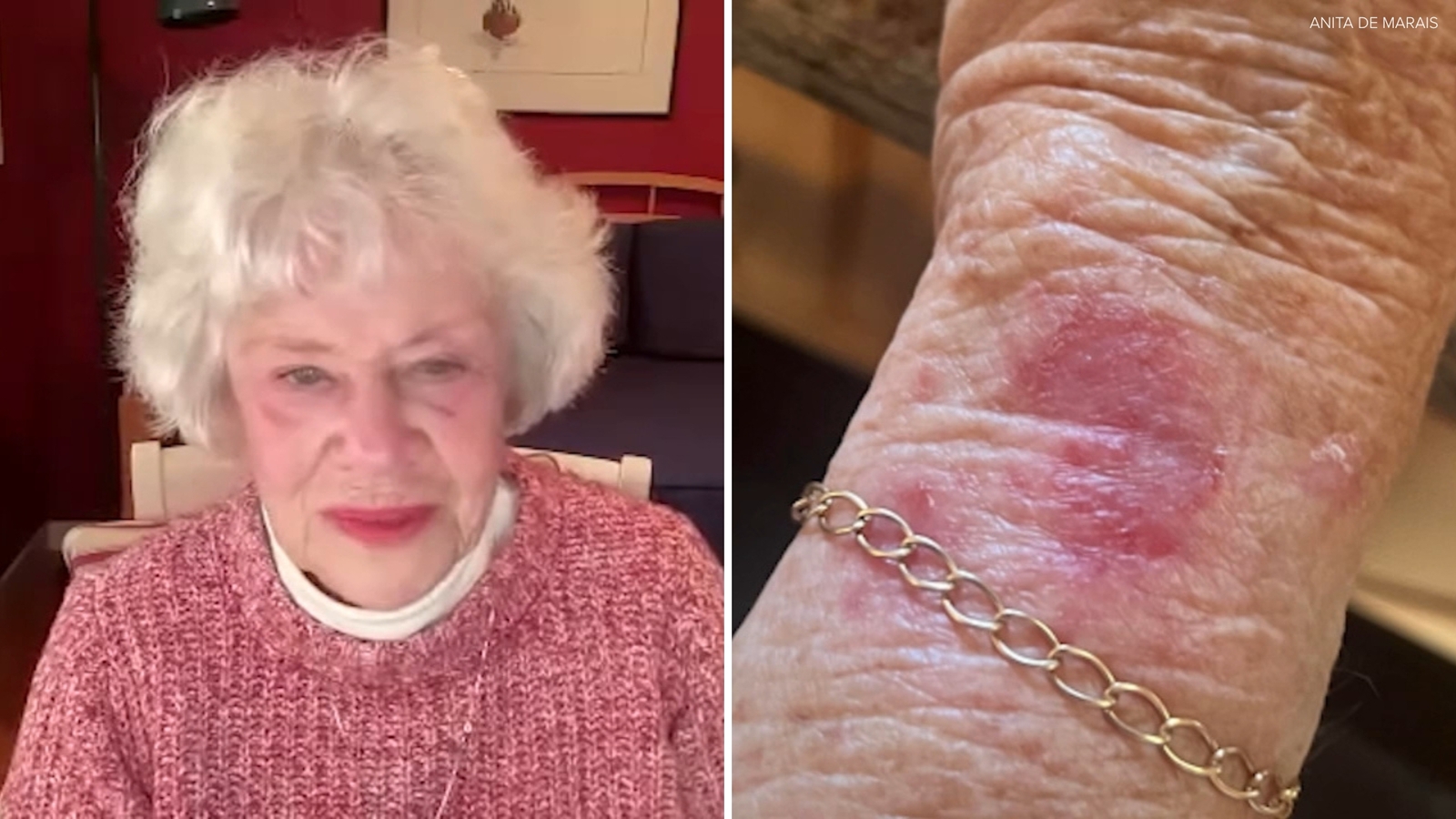 7 On Your Side: San Leandro 90-year-old's Apple Watch causes mysterious 'big red spot' on wrist