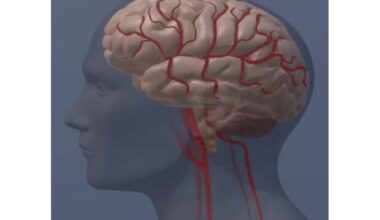 Protein buildup in brain blood vessels linked with increased 5-year risk of dementia