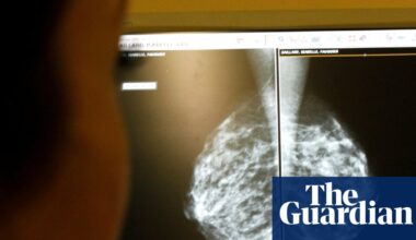 AI use in breast cancer screening cuts rate of later diagnosis by 12%, study finds | Cancer research