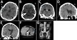 Computed tomography (CT) images of brain, abdomen, and spine of 79-year-old man with chronic obstructive pulmonary disease and large B-cell lymphoma who had disseminated Nocardia ignorata infection, United States. A–E) Brain CT with and without contrast showing multiple regular peripheral enhancing brain lesions (indicated by arrow and lowercase letters a and b) measuring 2.2 cm at the left frontal lobe (A) and 3.8 cm at the right (B); mildly lobulated at the right posterior lateral temporal lobe (C); and moderate edematous mass (D), resulting in mild brain herniation (E). F, G) CT images of abdomen (F) and pelvis (G). An indeterminate complex lesion measuring 6.1 cm is seen in the spleen (F, arrow).